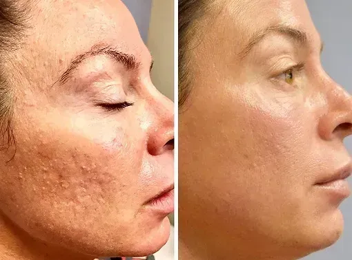 Före och efter Microneedling