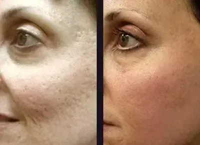 Före och efter Microneedling
